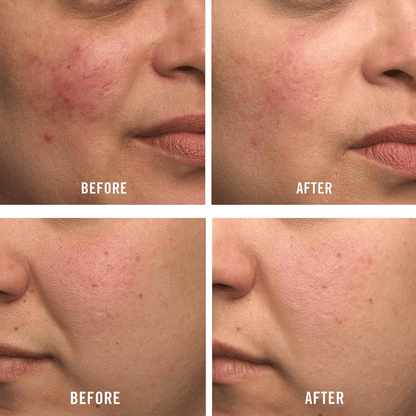 Before and after image showing skin improvement with First Aid Beauty Ultra Repair Hydrating Serum on acne-prone skin.