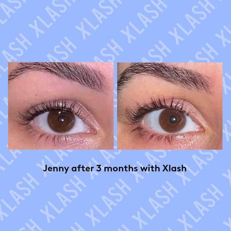 Before and after comparison of eyelash improvement after 3 months of using XLash serum.