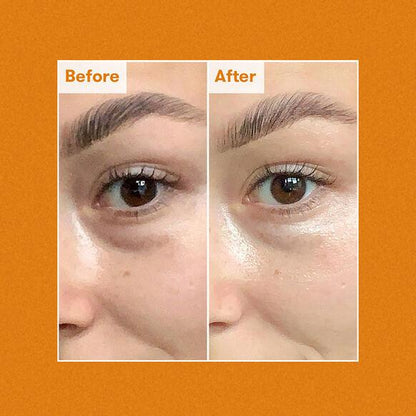 Before and after results of using Ren Clean Skincare Brightening Dark Circle Eye Cream, showing reduced dark circles.